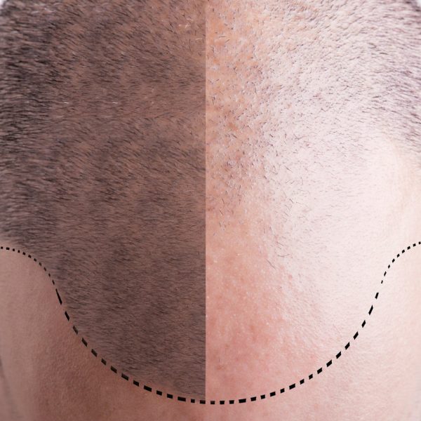Révolution : Dermopigmentation médicale et esthétique du cuir chevelu !