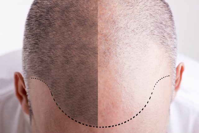 Révolution : Dermopigmentation médicale et esthétique du cuir chevelu !