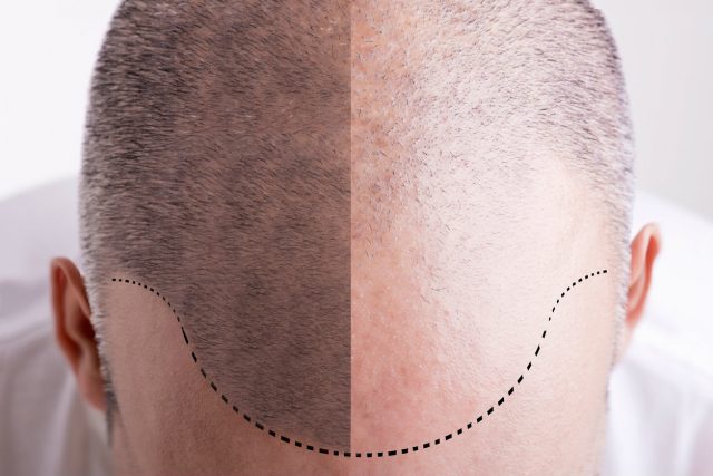 Révolution : Dermopigmentation médicale et esthétique du cuir chevelu !